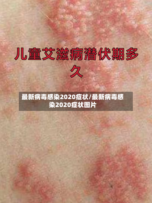最新病毒感染2020症状/最新病毒感染2020症状图片-第3张图片